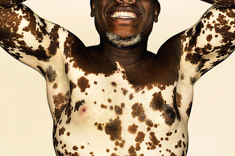 Vitiligo © Brock Elbank