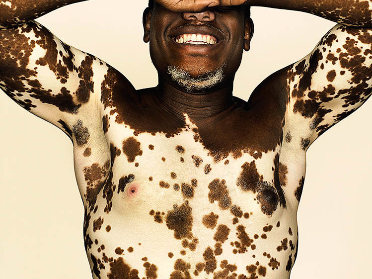 Vitiligo © Brock Elbank