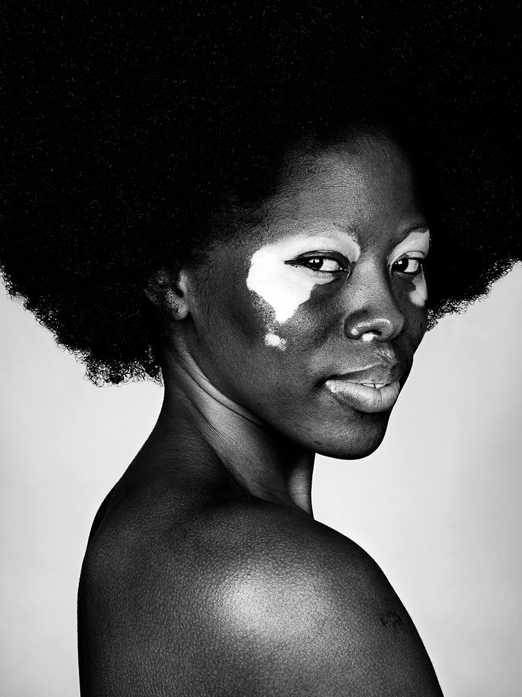 Vitiligo © Brock Elbank