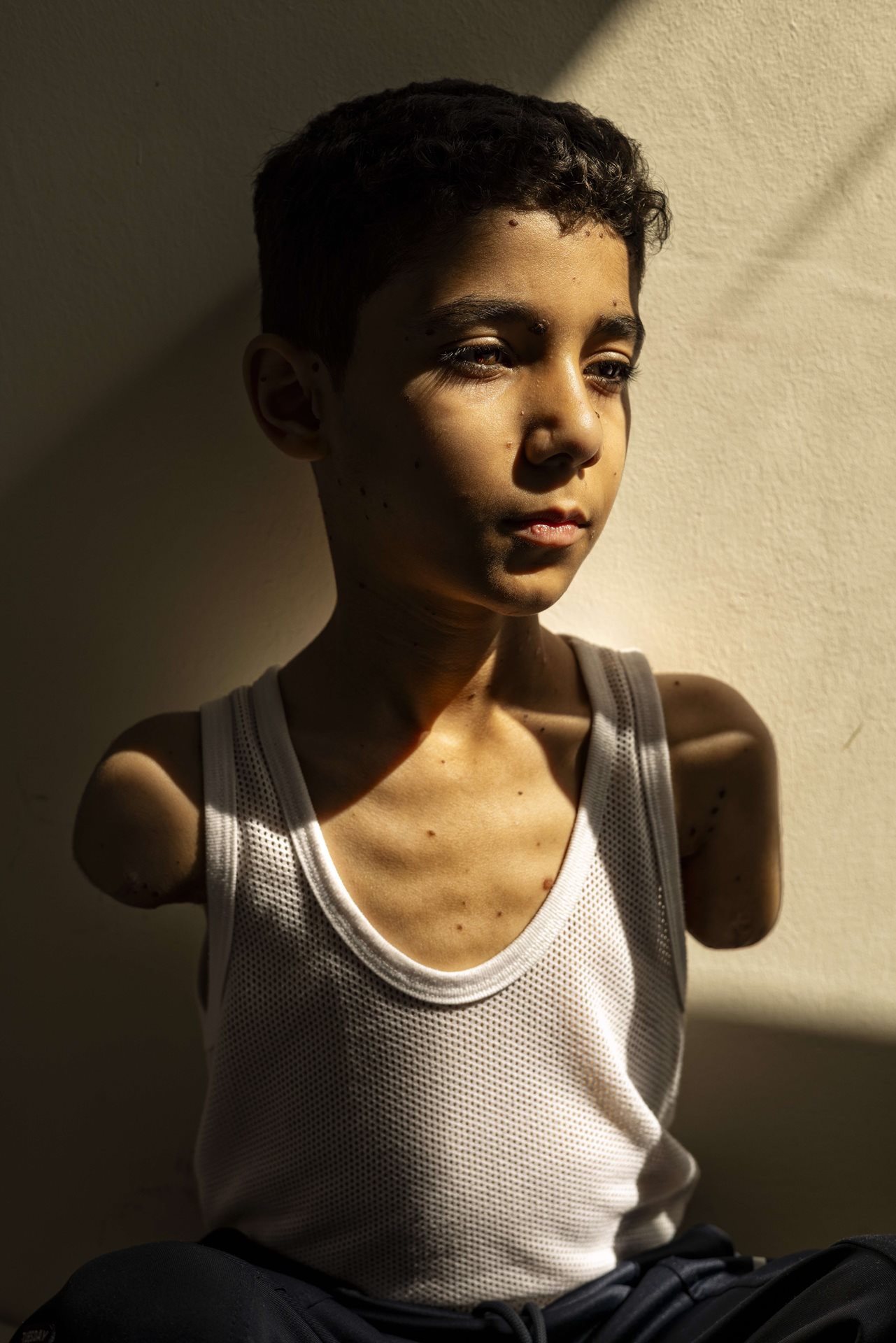 2025 Photo Contest - World Press Photo of the Year Mahmoud Ajjour, Aged Nine © Samar Abu Elouf